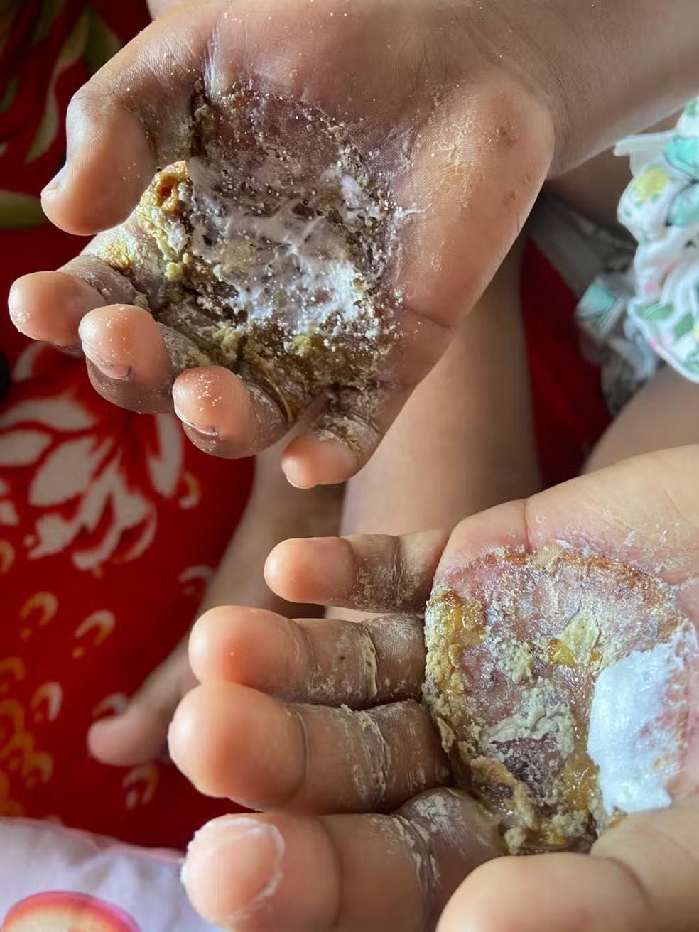 Mãe é presa em Niterói por torturar filha com ovos ferventes