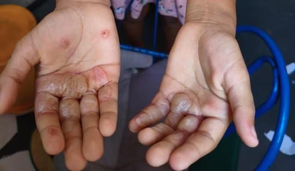 Mãe suspeita de queimar mãos da filha com ovos quentes é liberada em audiência de custódia